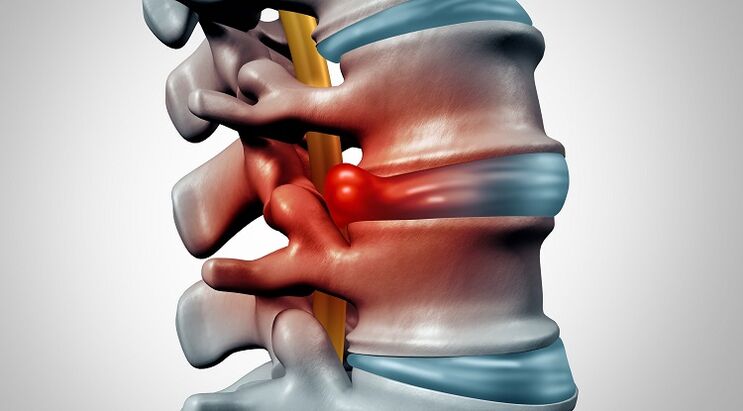 A gerinc dorsopathiájának tünetei és kezelése Ízületi fájdalom